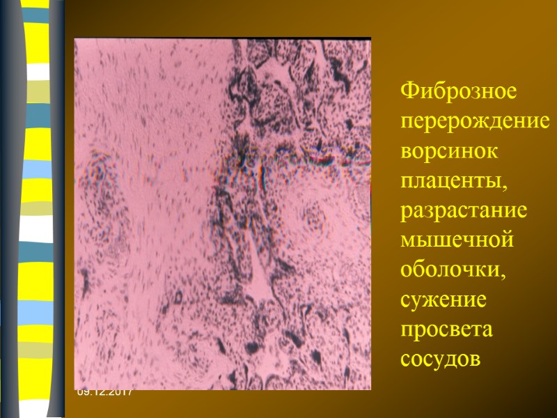 09.12.2017 Фиброзное перерождение ворсинок плаценты, разрастание мышечной оболочки, сужение просвета сосудов